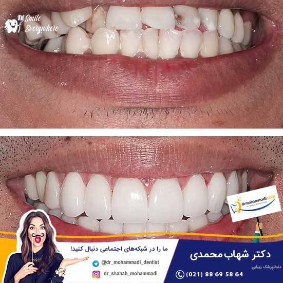 عکس های قبل و بعد کامپوزیت دندان - کلینیک دندانپزشکی دکتر شهاب محمدی